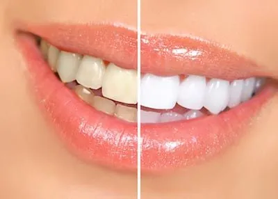 before and after look at Zoom teeth whitening